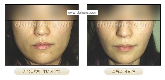 [두한성형외과 각진 얼굴을 갸름한 얼굴형으로의 변신] - [사각턱 보톡스] 관련 이미지 11