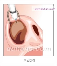 [두한성형외과 경쟁력 코성형 리더] - [자연스럽고 오똑한 콧망울! 코성형 방법]​ 관련 이미지 2