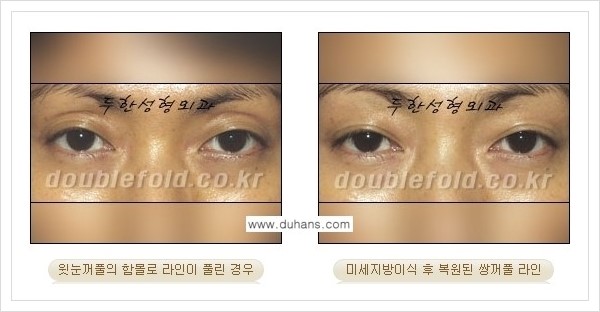 [두한성형외과 경쟁력 쌍꺼풀 재수술(극한 재수술)] - [라인이 풀렸을 경우의 쌍꺼풀 재수술 안내 ②] 관련 이미지 8