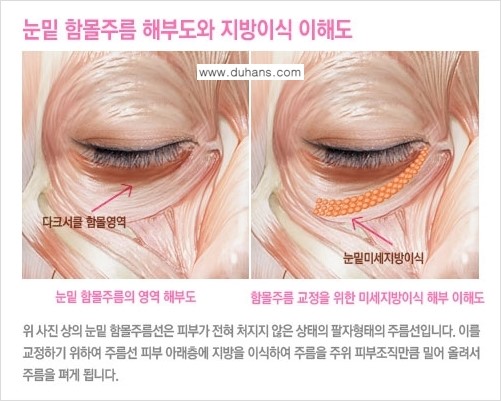 [두한성형외과 FOCUS 눈밑성형] - [다크써클의 치료방법 -  콜펫(Col-fat) 눈밑 미세지방이식 ④] 관련 이미지 7
