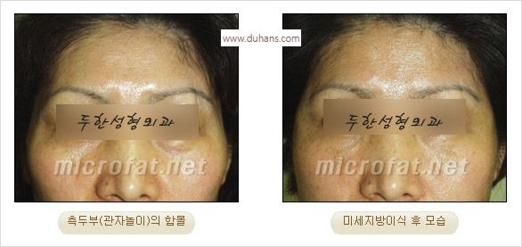 [두한성형외과 경쟁력 미세지방이식] - [관자놀이(측두부) 지방이식] 관련 이미지 6