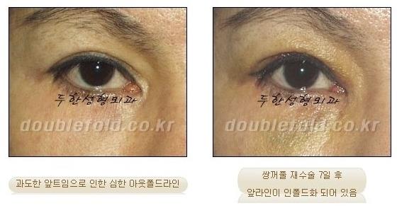 [두한성형외과 경쟁력 쌍꺼풀 재수술, 극한 눈재수술] - [망친 쌍꺼풀, 망가진 쌍꺼풀 복원수술, 재수술의 성공요건] 관련 이미지 4