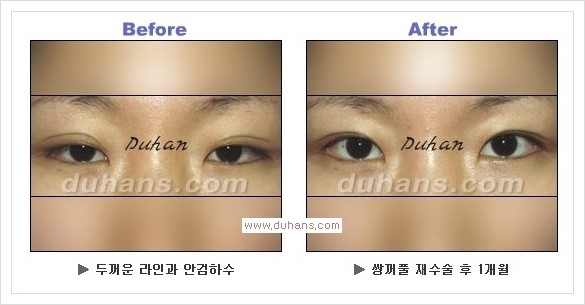 [두한성형외과 경쟁력 눈성형] - [안검하수(졸리운 눈매)의 종류와 교정 방법 안내] 관련 이미지 10