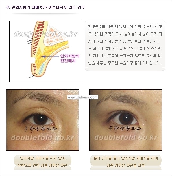 [두한성형외과 경쟁력 쌍꺼풀 재수술(눈재수술)] - [쌍꺼풀 재수술(눈재수술)의 실패의 원인 분석] 관련 이미지 4