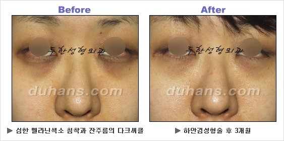 [두한성형외과 경쟁력 동안성형 리더] - ​[미간주름, 이마주름, 안검성형, 이마거상술, 눈썹거상술] 관련 이미지 121