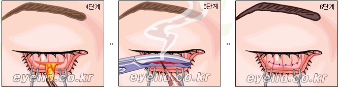 [두한성형외과 지방제거] - [눈두덩이지방제거, 눈밑지방제거] 관련 이미지 13