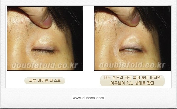[두한성형외과 쌍꺼풀 재수술] - [쌍꺼풀 재수술 상담시 검사와 테스트] 관련 이미지 1