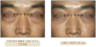 [두한성형외과 지방제거] - [눈두덩이지방제거, 눈밑지방제거] 관련 이미지 45