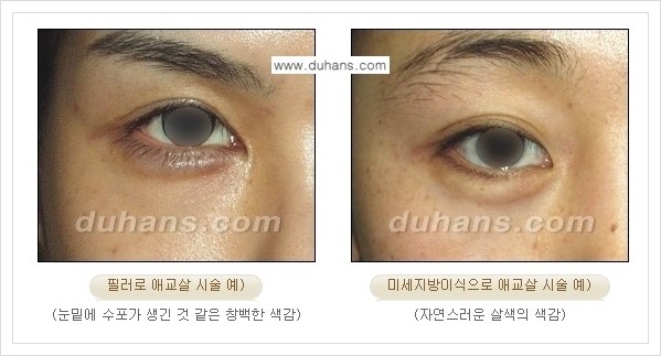 [두한성형외과 경쟁력 눈밑성형] - [눈밑 애교살 시술을 위한 미세지방이식 안내] 관련 이미지 10