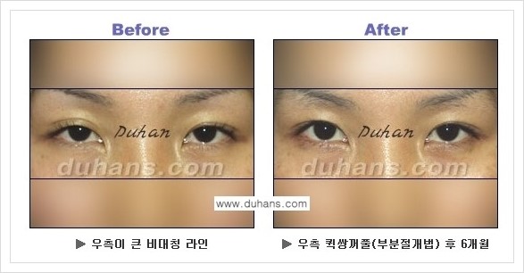 [두한성형외과 경쟁력 눈성형] - [퀵쌍꺼풀 수술 전후 정보 안내 ②] 관련 이미지 10