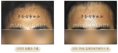 Fat Grafting Leader Duhan Plastic Surgery - Everything About Fat Grafting image 7