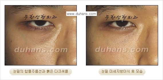 [두한성형외과 경쟁력 미세지방이식] - [다크써클 & 눈밑주름 미세지방이식 5.] 관련 이미지 10