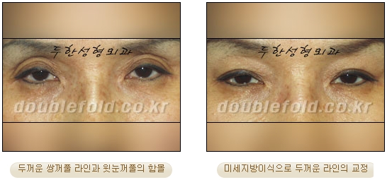 [두한성형외과 눈재수술] - [지방이식과 쌍꺼풀재수술 동시에 하는 경우] 관련 이미지 11