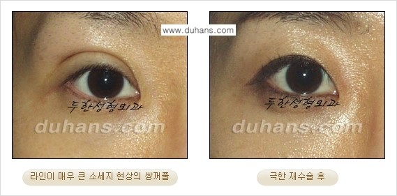 ⁠⁠⁠⁠[두한성형외과 성형 FOCUS] - [정상적인 눈매로의 복원 극한재수술 경우 ①] 관련 이미지 7