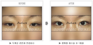 두한성형외과 쌍커풀 재수술 - 짝눈 눈매교정, 가성 안검하수 교정과 뒤밑트임 관련 이미지 53