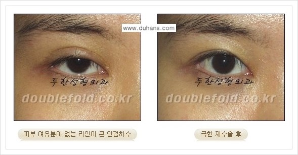 [두한성형외과 경쟁력 쌍꺼풀 재수술] - [극한의 상태에서 쌍꺼풀 재수술 안내 ②] 관련 이미지 11