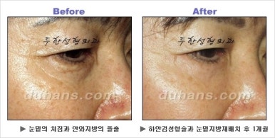 [두한성형외과 안검성형] - [상안검, 하안검] 관련 이미지 32