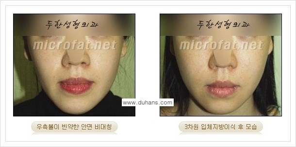 [두한성형외과 경쟁력 볼살지방이식] - [사각턱의 경우, 측면 볼살의 함몰선, 안면비대칭, 남성 야윈볼살 안내] 관련 이미지 9
