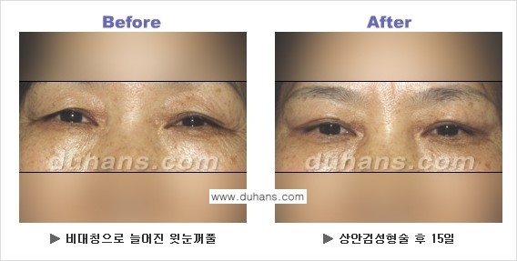 [두한성형외과 NO.1 눈성형] - [상안검 수술에 대한 정보] 관련 이미지 2