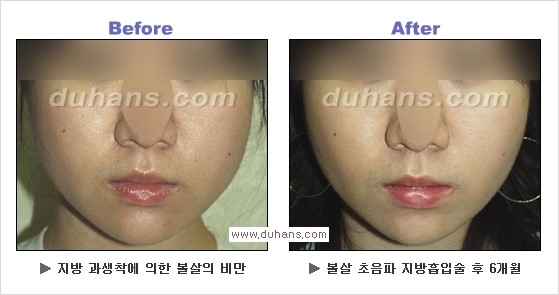 [두한성형외과 경쟁력 얼굴지방흡입] - [통통한 볼살, 두툼한 턱살(턱선)의 지방흡입] 관련 이미지 15
