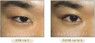 [Double Eyelid Surgery Duhan Plastic Surgery] - [Buried Method, Incision Method, Partial Incision Method] image 20