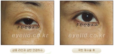 Duhan Plastic Surgery Ophthalmic Reoperation - What Is a Successful Double Eyelid Revision Surgery? image 29