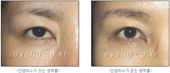 쌍커풀수술 두한성형외과 - 나에게 맞는 눈성형은? 관련 이미지 14
