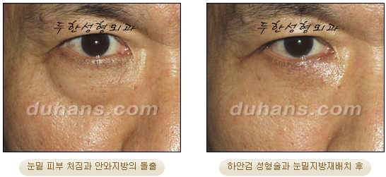 [Duhan Plastic Surgery Ophthalmic Plastic Surgery] - [Lower Blepharoplasty] image 13