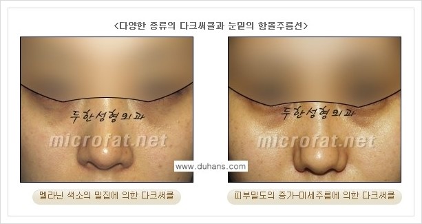 [두한성형외과 경쟁력 눈밑성형] - [눈밑 다크써클, 눈밑 주름의 교정 안내 1.] 관련 이미지 3