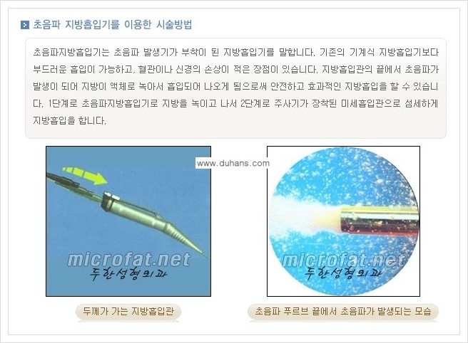 [두한성형외과 경쟁력 얼굴지방흡입] - [통통한 볼살, 두툼한 턱살(턱선)의 지방흡입] 관련 이미지 4