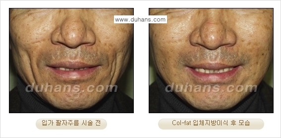[두한성형외과 경쟁력 미세지방이식]-[Col-fat 입체지방이식 사례 안내] 관련 이미지 10