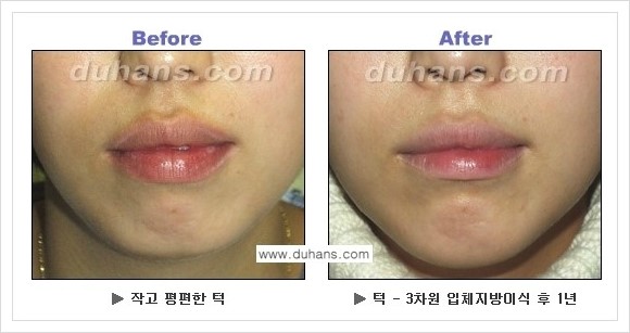 [두한성형외과 경쟁력 미세지방이식] - [아름다운 얼굴선 - 무턱, 오목턱, 비대칭턱 지방이식 안내] 관련 이미지 18
