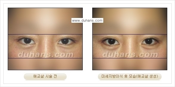 [두한성형외과 경쟁력 눈밑성형] - [눈밑 애교살 시술을 위한 미세지방이식 안내] 관련 이미지 7