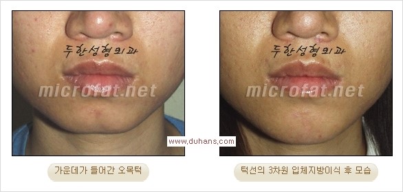 [두한성형외과 경쟁력 미세지방이식] - [부드럽고 아름다운 얼굴윤곽선 턱(하악부) 미세지방이식 안내] 관련 이미지 12