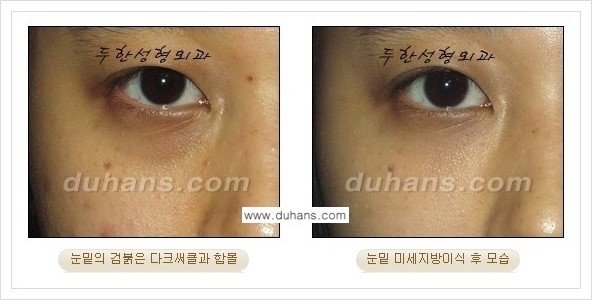 [두한성형외과 경쟁력 미세지방이식] - [눈 주위를 밝고 젊게 보이는 눈밑 미세지방이식] 관련 이미지 27