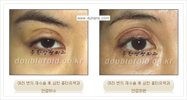 [두한성형외과 경쟁력 쌍꺼풀 재수술, 극한 눈재수술] - [쌍꺼풀 재수술, 극한 눈재수술 관련 자주하는 질문과 답변] 관련 이미지 1