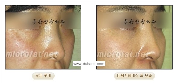 [두한성형외과 경쟁력 코성형] - [미세지방이식을 이용한 자연스러운 코성형 안내] 관련 이미지 17