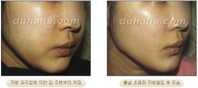 [두한성형외과 안전한 지방흡입] - [얼굴지방흡입] 관련 이미지 11