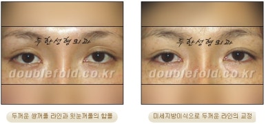 [Duhan Plastic Surgery Revision Double Eyelid Surgery] - [Double Eyelid Revision Surgery Process] image 37