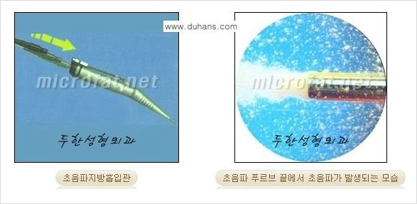 [두한성형외과 경쟁력 바디성형] - [하복부, 팔뚝, 허리선, 허벅지, 엉덩이 간편지방흡입술] 관련 이미지 4
