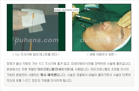[두한성형외과 경쟁력 미세지방이식] - [코 지방이식 1.] 관련 이미지 8