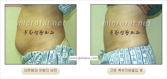 [두한성형외과 경쟁력 간편지방흡입] - [복부(뱃살) 비만 간편지방흡입] 관련 이미지 17