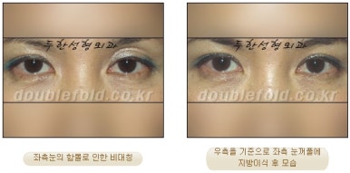 [두한성형외과 쌍커풀수술] - [쌍꺼풀지방이식] 관련 이미지 31