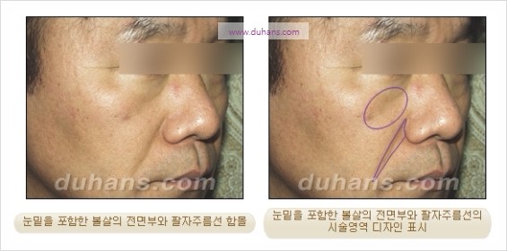 [두한성형외과 경쟁력 귀족성형] - [3차원 입체 미세지방이식 귀족수술 + 인디언밴드 교정] 관련 이미지 7