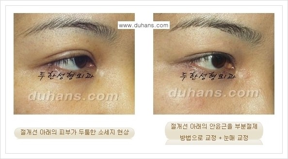 [두한성형외과 경쟁력 쌍꺼풀 재수술(극한 재수술)] - [절개선 아래가 두툼한 소세지 현상 안내] 관련 이미지 6
