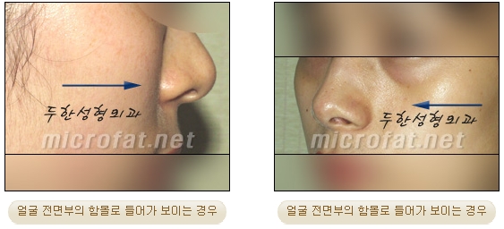 [두한성형외과 지방이식] - [귀족수술과 인디언밴드 교정] 관련 이미지 1