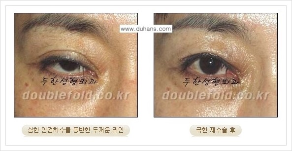 [두한성형외과 경쟁력 쌍꺼풀 재수술, 극한 눈재수술] - [쌍꺼풀 재수술, 극한 눈재수술 관련 자주하는 질문과 답변] 관련 이미지 4