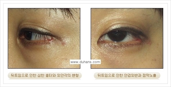 [두한성형외과 경쟁력 쌍꺼풀 재수술, 극한 눈재수술] - [뒤트임 수술의 부작용 및 교정 방법 안내] 관련 이미지 4