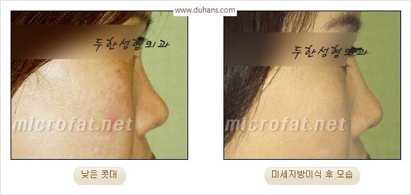 [두한성형외과 경쟁력 코성형 리더] - [자연스럽고 오똑한 콧망울! 코성형 방법]​ 관련 이미지 50