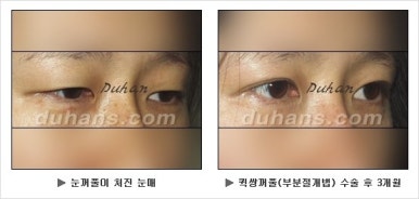 [두한성형외과 쌍커풀수술] - [매력적인 쌍커풀] 관련 이미지 43